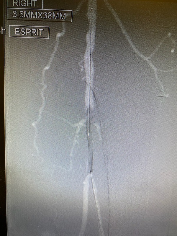 EspiritTM procedure